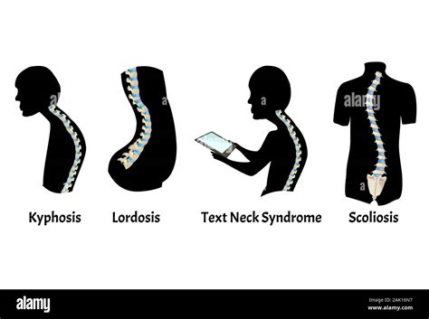 The Position Of The Spine With Lordosis Kyphosis Text Neck Syndrome