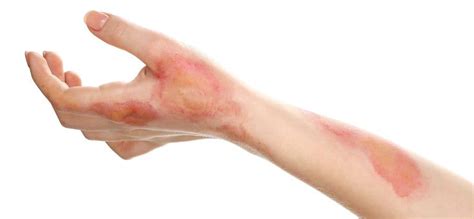 Treating Burns And Scalds Is Important In First Aid Training
