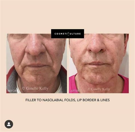 Lower Face Fillers Sydney Cosmetic Culture