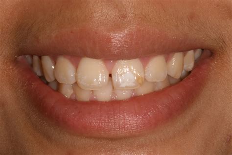 Teeth Treat White Spots On Teeth After Whitening