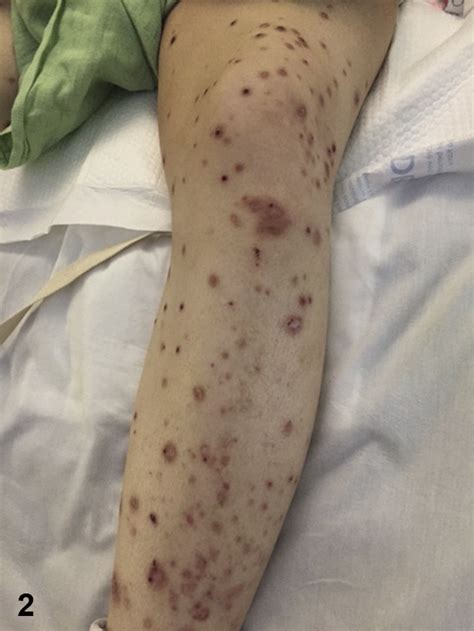 Diffuse Pruritic Papules Jaad Case Reports