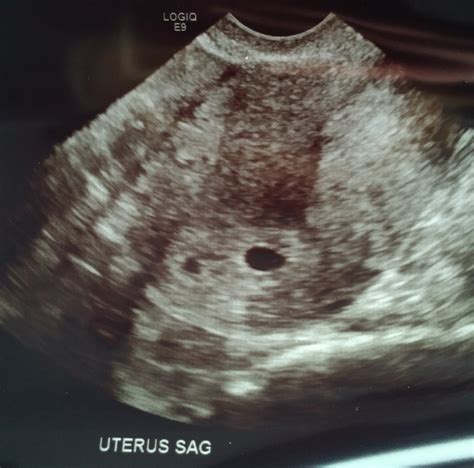 Ultrasound Pictures Of Twins At 5 Weeks Picturemeta