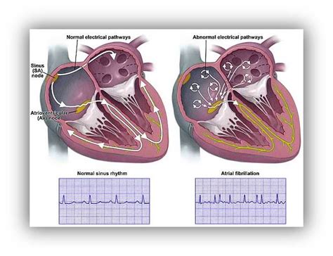 Arrhythmia And Left Atrial Appendage Therapies Dr Krasopoulos