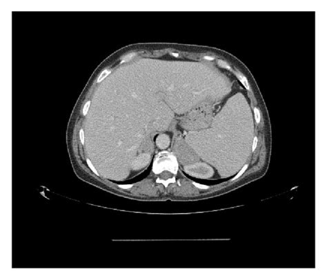 Ct Of The Abdomen Showing Bilateral Homogenous Adrenal Gland