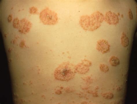 Nummular Eczema Nummular Eczema Pictures Nummular Eczema Treatment