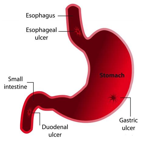 Throwing Up Stomach Acid Causes Preventions And Treatments