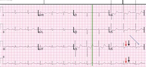 Dr Smith S ECG Blog Are These Wellens Waves