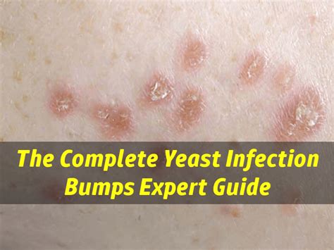 Vaginal yeast infections are a common problem affecting most women at least once. Yeast Infection Bumps - Are Your Skin Bumps Caused By ...