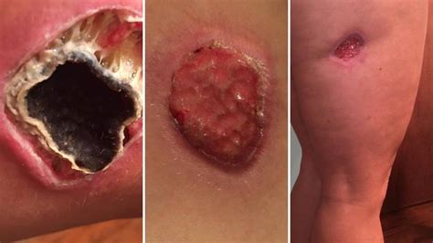 Horrifying Photos Reveal Spider Bite Victims 12 Month Ordeal After