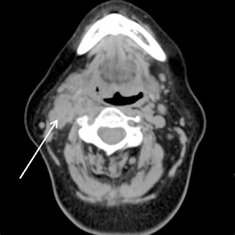The Excised Cervical Lymph Node Demonstrated Squamous Carcinoma A