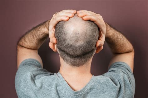 How To Regrow Hair On Bald Spot Fast Wimpole Clinic