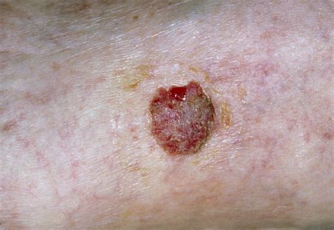Squamous Cell Cancer Of Skin On Leg Stock Image M1310136 Science