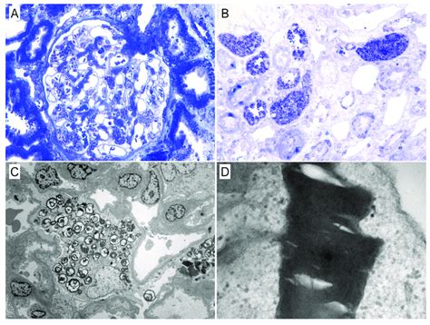 Kidney Biopsy Findings From Patient No 11 A Light Microscopy Image