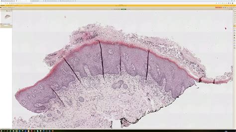 Candida Yeast Infection Of Skin Candidiasis 5 Minute Pathology Pearls