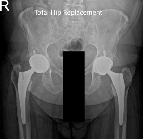 Case Study Bilateral Hip Replacement In A 65 Year Old Female