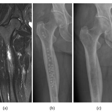 Antibiotic Loaded Pmma Beads Utilized In Orthopedic Procedures In The