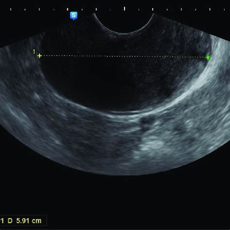Transvaginal Ultrasound Imaging Sagittal View Of A Mass On The