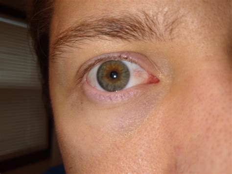 Eye Redness Probably Caused By Dry Eye How Concerned Should I Be R