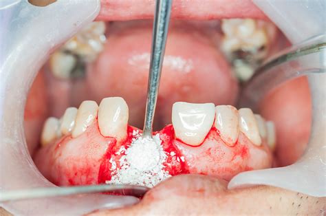 トリー Bone Augmentation In Implant Dentistry ボーンオグ