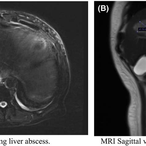 A Axial Mri Section Showing Liver Abscess B Mri Sagittal View