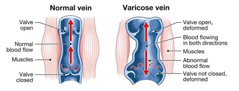 The Truth About Varicose Vein Supplements And Creams The Vein Institute