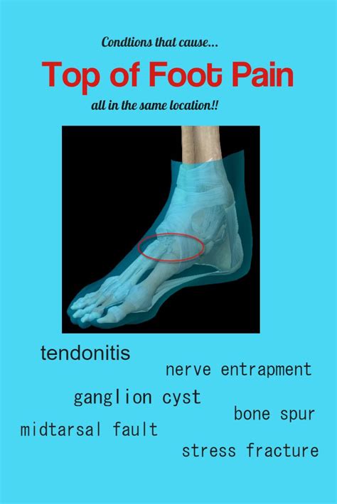 Bottom Of Foot Pain Chart