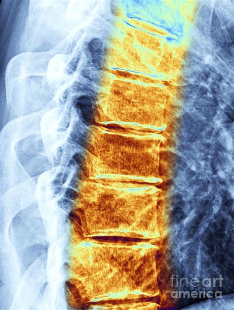 Osteoarthritis Of The Thoracic Spine Photograph By Alfred Pasieka Pixels