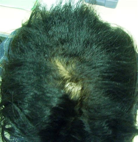 The Hair Loss Centre Female Hair Loss Treated Photos