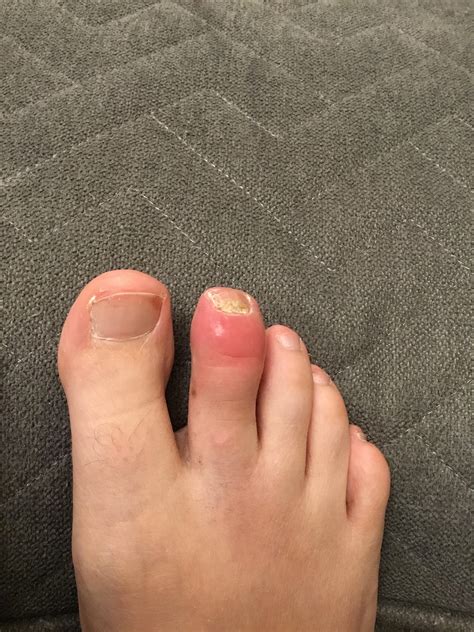 My Toe Hates Me Rpsoriaticarthritis