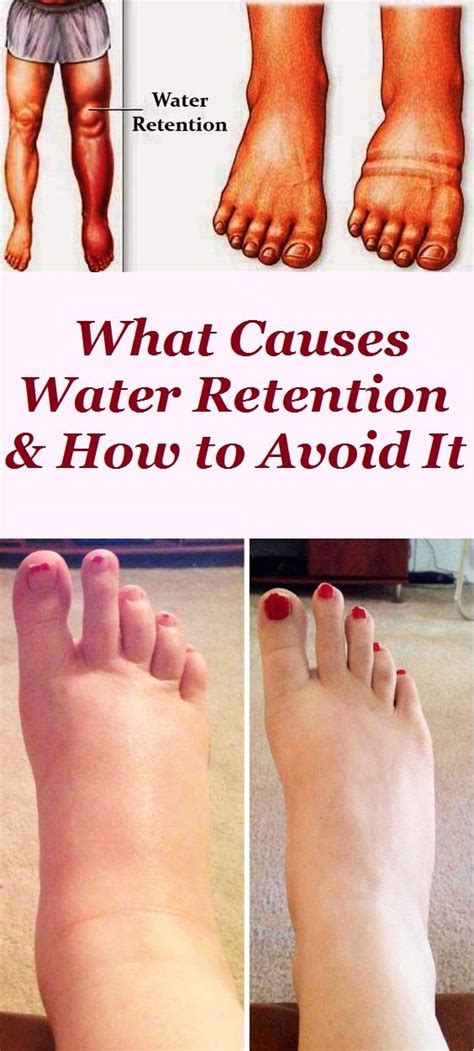 What Causes Water Retention And How To Avoid It With Images