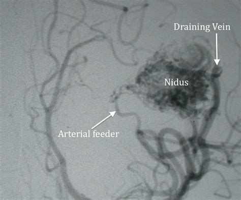 What Is An Arteriovenous Malformation Avm Nj Treatment