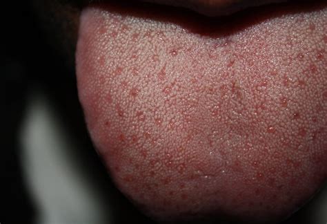 Ridges On Side Of Tongue Cure And Prevention