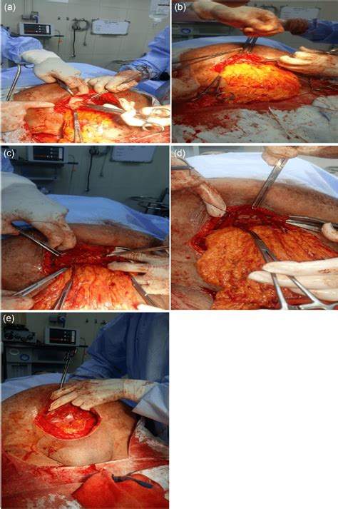 Operative Steps Of Management Of Paraumbilical Hernia During Cesarean