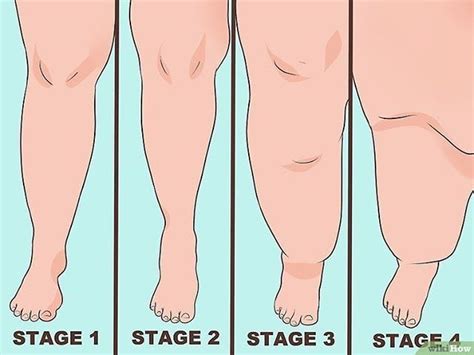 Understand The Stages Of Lipedema As With Many Disorders And Diseases
