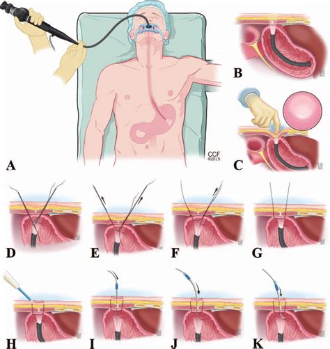 Percutaneous Endoscopic Gastrostomy Performed With The Seldinger