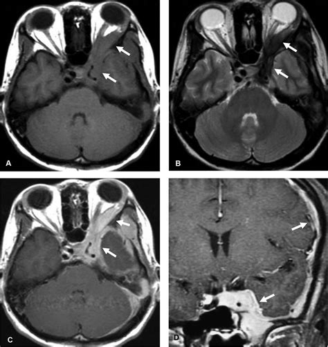 Idiopathic Hypertrophic Pachymeningitis Ihp Axial T1 Weighted Image