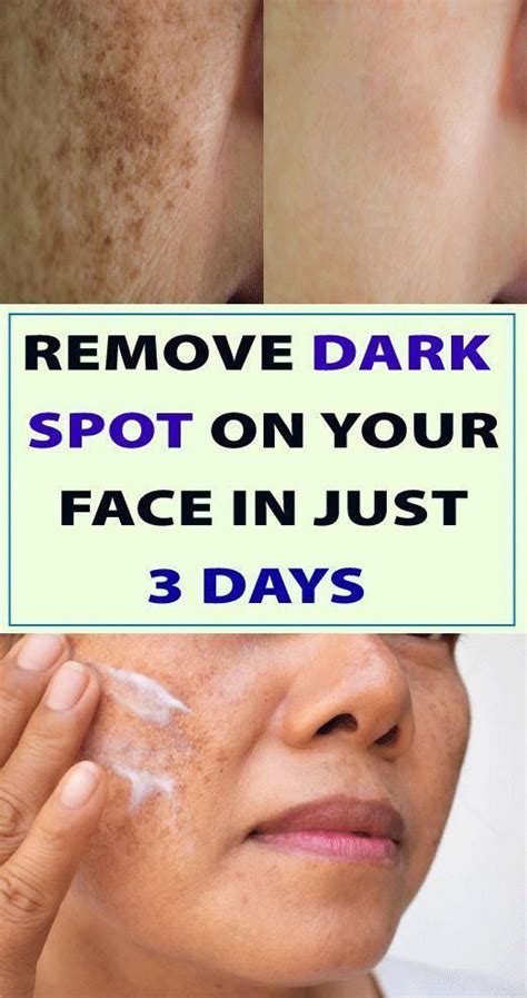 in just 3 nights remove dark spots on your face naturally remove dark spots good skin tips