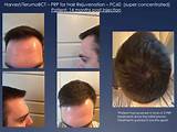 Photos of Stem Cell Treatment For Hair Loss Side Effects