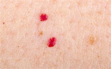 Diabetes Red Spots On Legs How To Remove Cherry Angiomas Red Moles