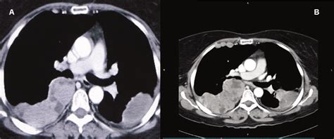A Chest Ct Scan With Iv Contrast Performed 7 Months After The First