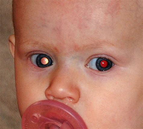 Retinoblastoma Symptoms In Babies Retinal Blastoma Tumors Eye Crpodt