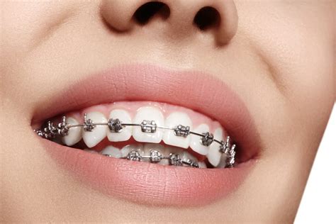 How Does Braces Work To Align Your Teeth Park Dental Clinic