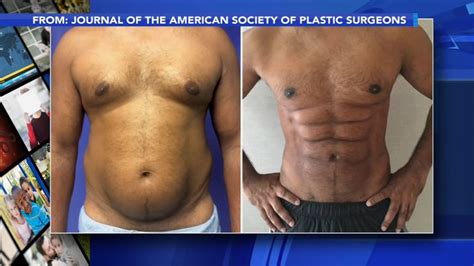 New Procedure Uses Foam To Sculpt Belly Fat Into 6 Pack Abs 6abc
