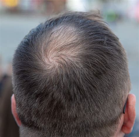 A Bald Spot On A Man S Head Alopecia Stock Photo Image Of Health