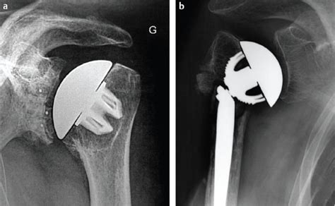 27 Stemless Humeral Technology In Reverse Shoulder Arthroplasty Is It
