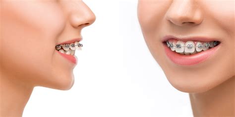 Can Invisalign Fix Overbite And Crooked Teeth Teethwalls