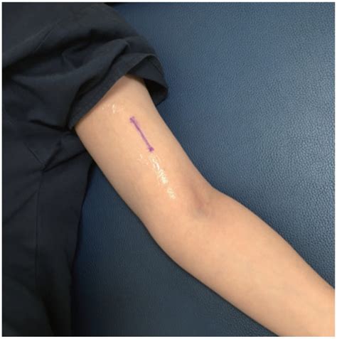Experiences Of Localization And Removal Of Non Palpable Subdermal