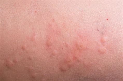 What Are The Common Causes Of Hives On The Legs