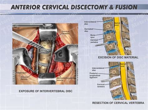 Anterior Cervical Diskectomy And Fusion Male Order