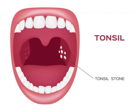 Tonsil Stones What Are They And Why Do I Get Them